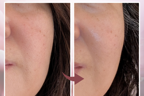 川口市南鳩ヶ谷の小顔フェイシャル施術前後のフェイスライン変化