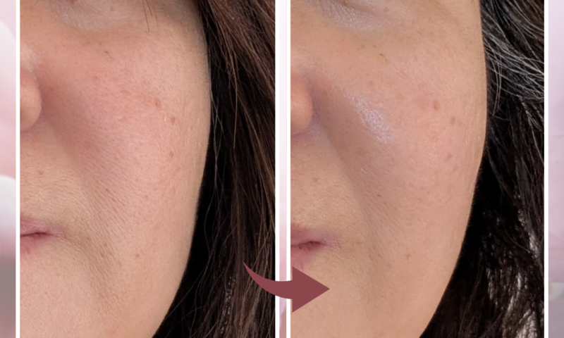 川口市南鳩ヶ谷の小顔フェイシャル施術前後のフェイスライン変化