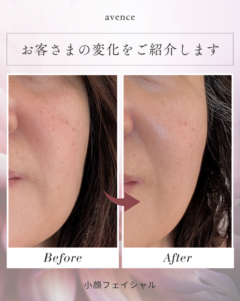川口市南鳩ヶ谷の小顔フェイシャル施術前後のフェイスライン変化